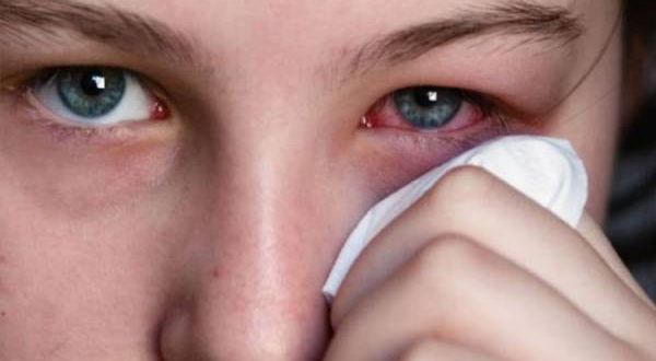 Cara mengobati sakit mata